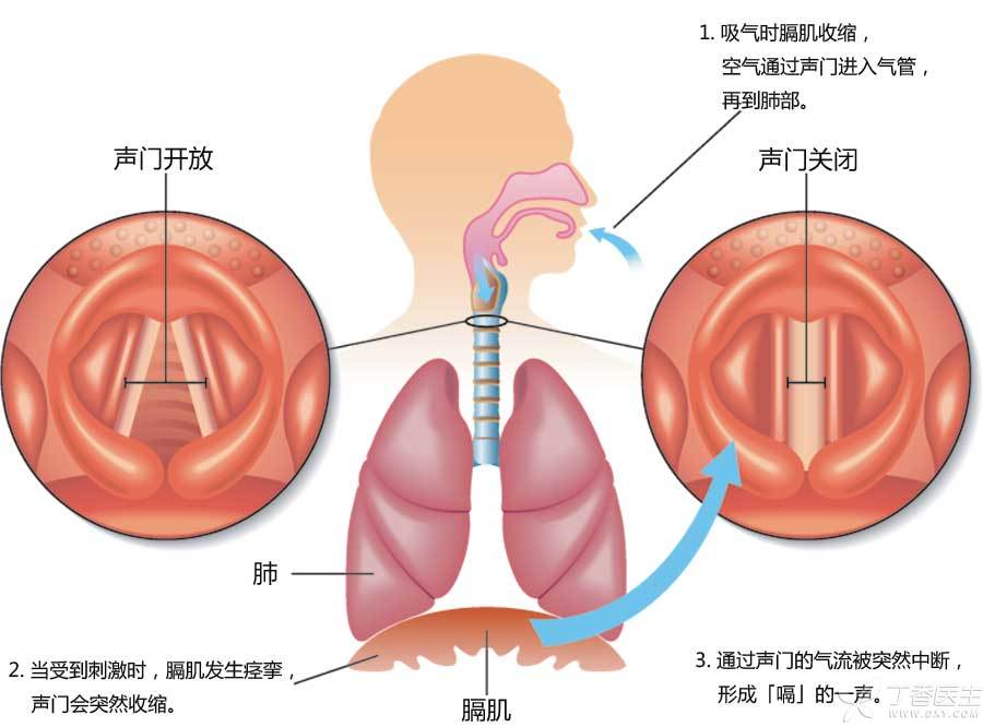喷门迟缓症最新疗法